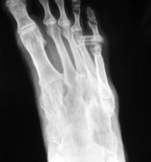 Radiografia de um pé humano mostrando as articulações