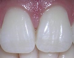 Dentes incisivos superiores médios