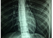 Medula espinal: localizada no interior das vértebras